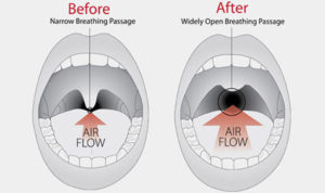 surgical-snoring-solutions