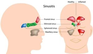 Sinus Treatment