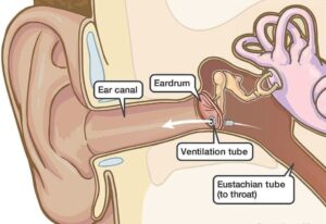 Ear Tubes