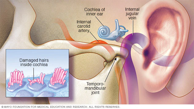 Causes Tinnitus