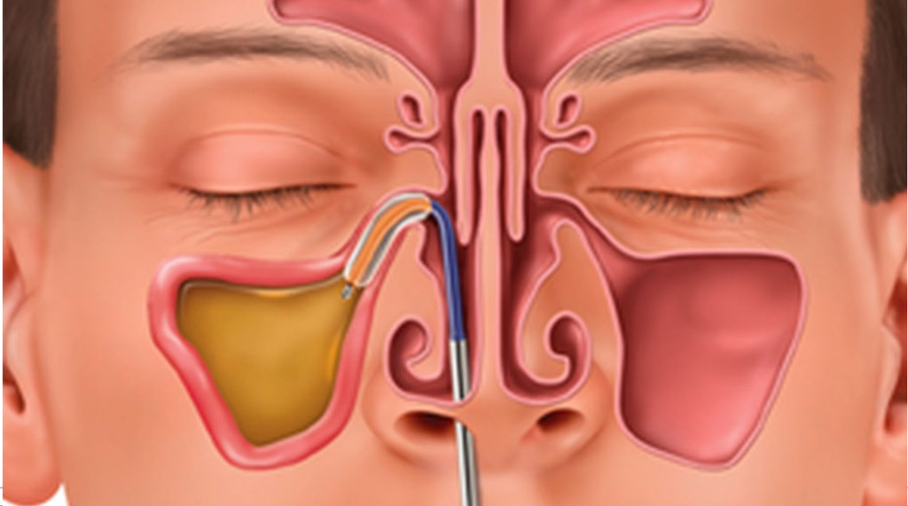 Balloon Sinuplasty